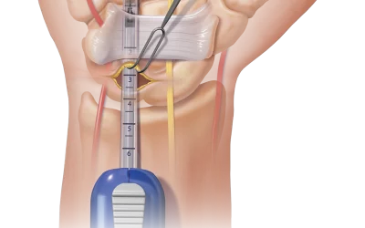 Chirurgie endoscopique du canal carpien : avantages et efficacité