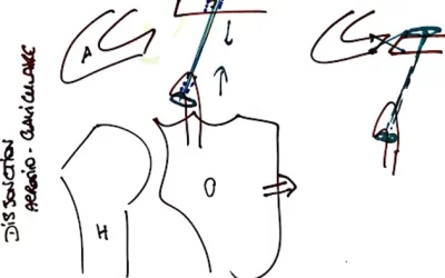 Disjonctions acromio-claviculaires et prise en charge chirurgicale
