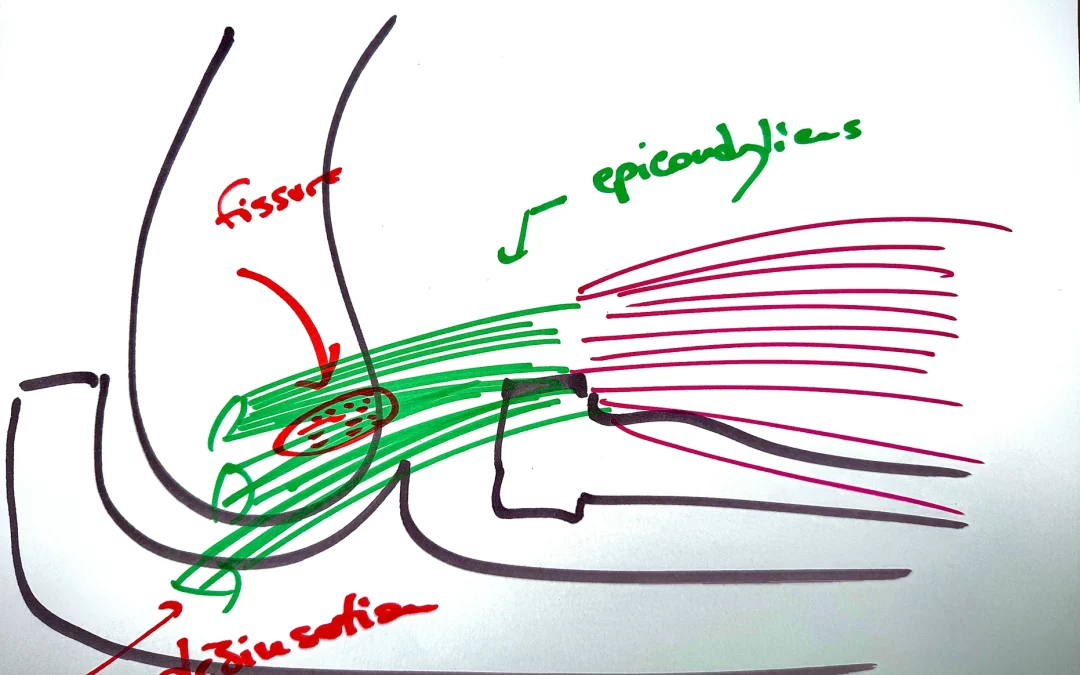 Comprendre et Traiter la pathologie de l’Épicondylite Latérale (Tennis Elbow)