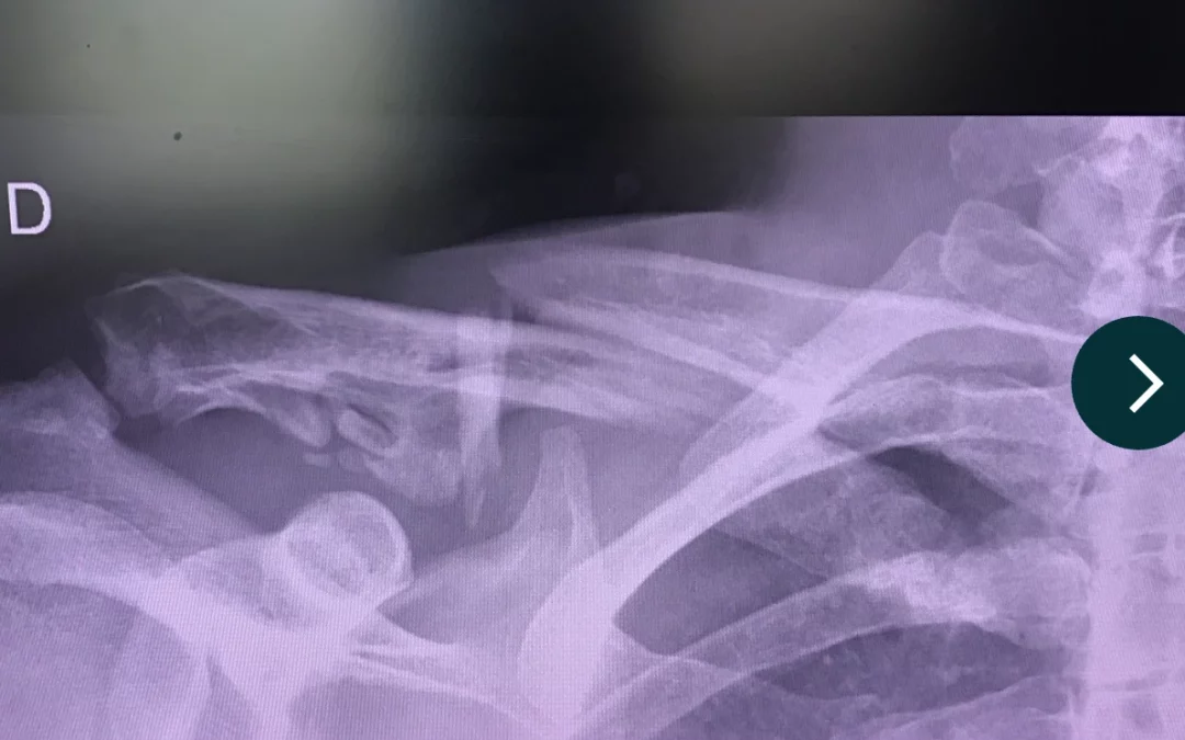 Comprendre et Traiter une Fracture de la Clavicule