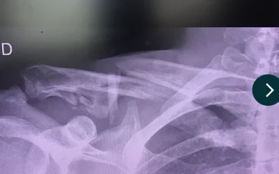 Comprendre et Traiter une Fracture de la Clavicule