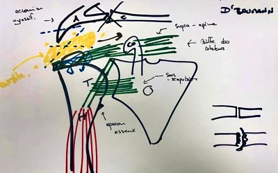 Réparation de la Coiffe des Rotateurs avec Acromion Agressif : Techniques Arthroscopiques Avancées